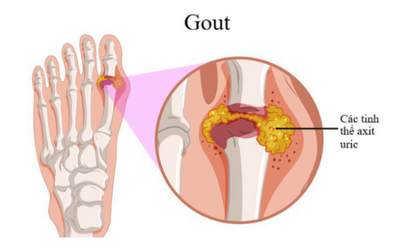 Hình ảnh bệnh nhân gout